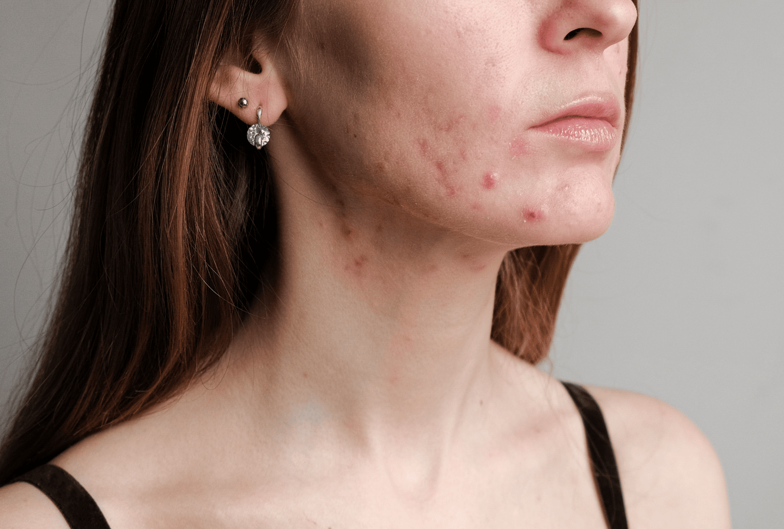 ACNE (1)