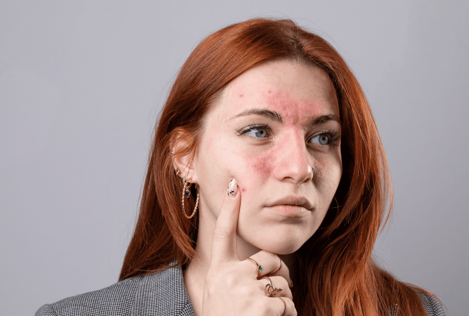 ACNE (10)