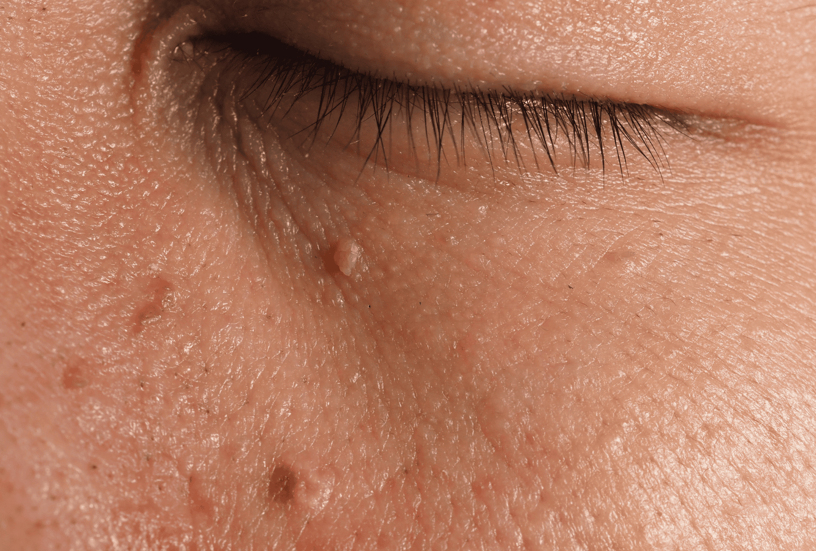 ACNE (12)