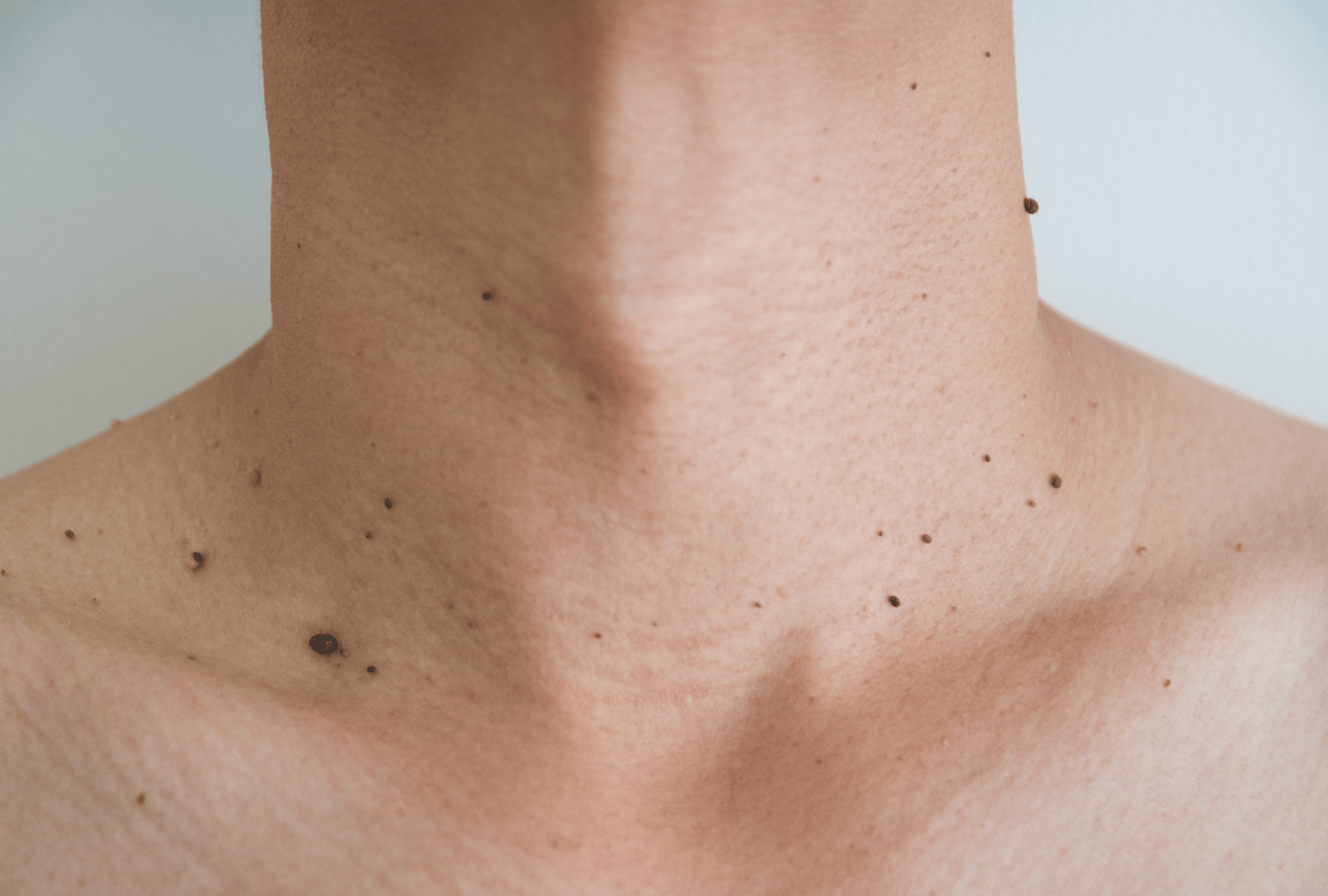 ACNE (13)