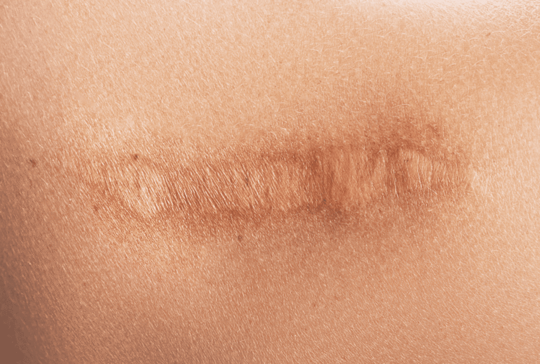 ACNE (17)