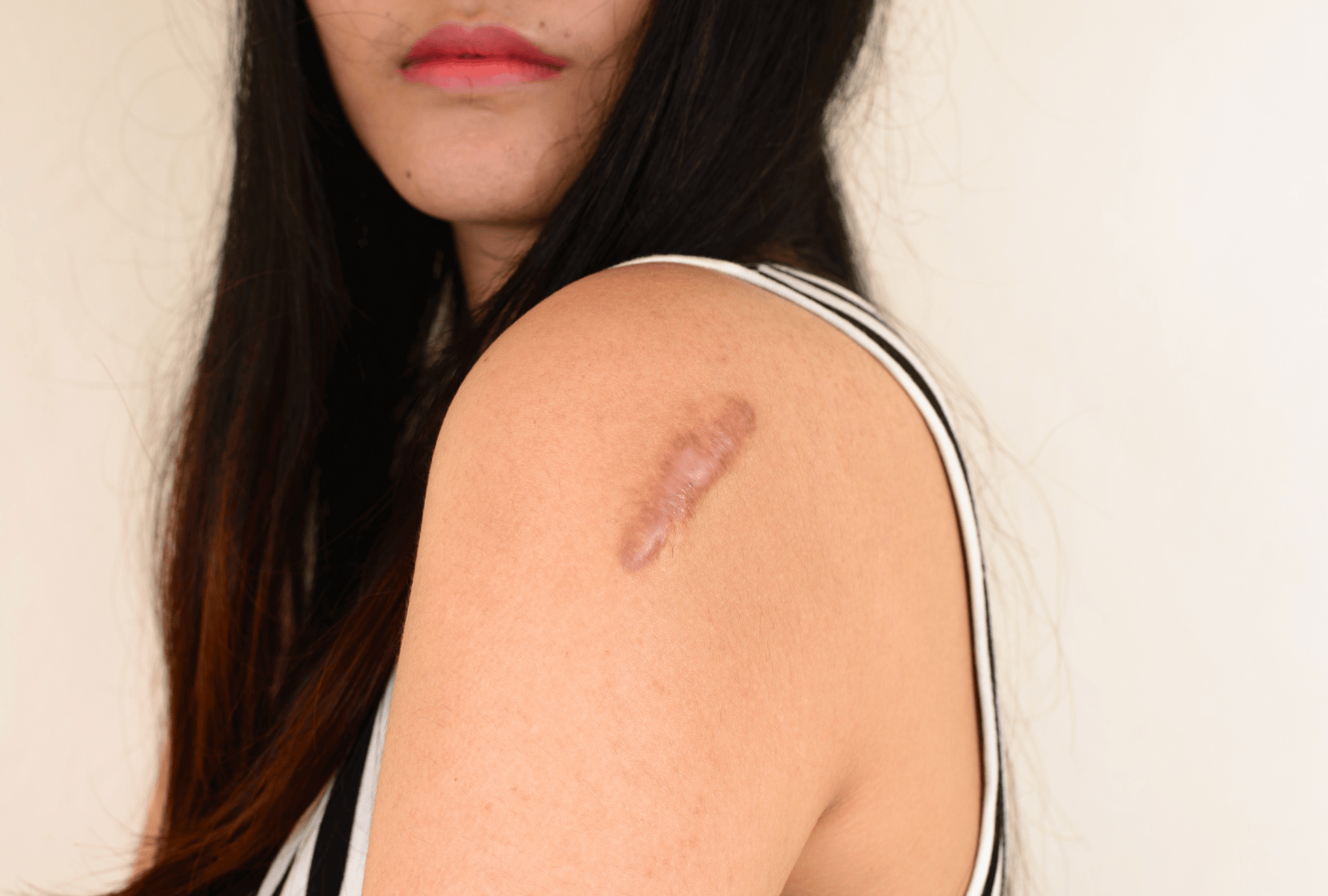 ACNE (22)