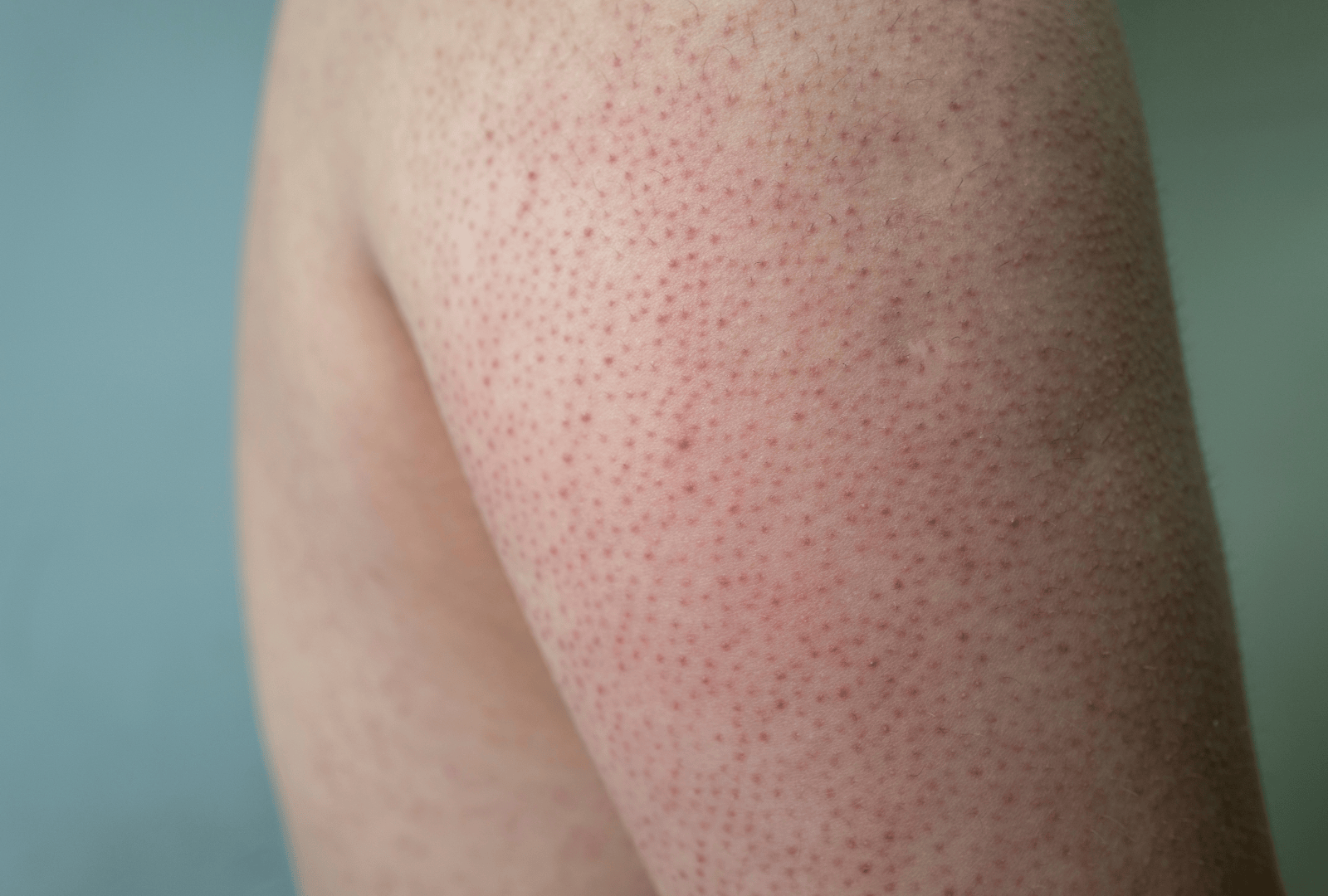 ACNE (28)