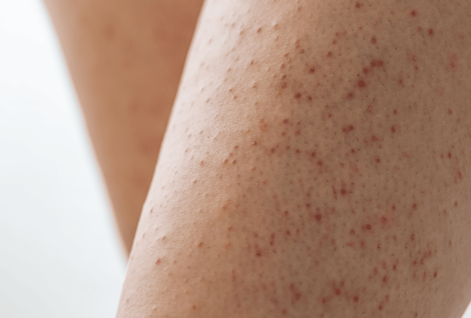 ACNE (29)