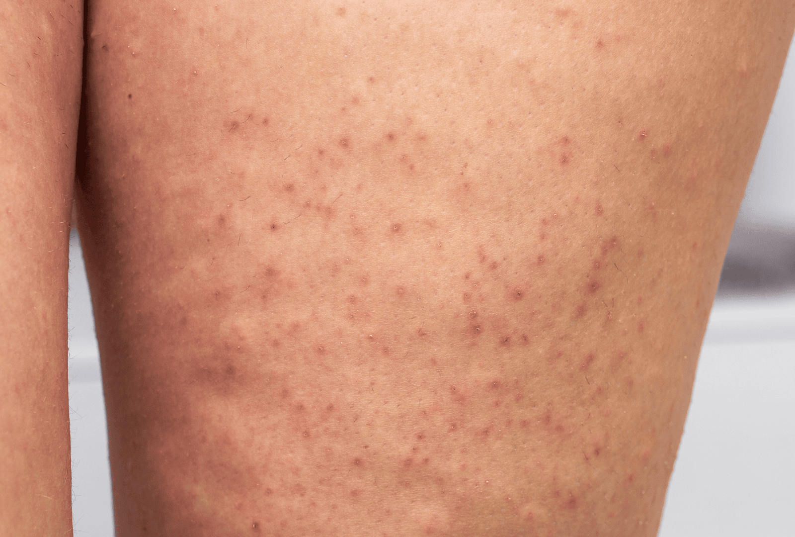 ACNE (30)