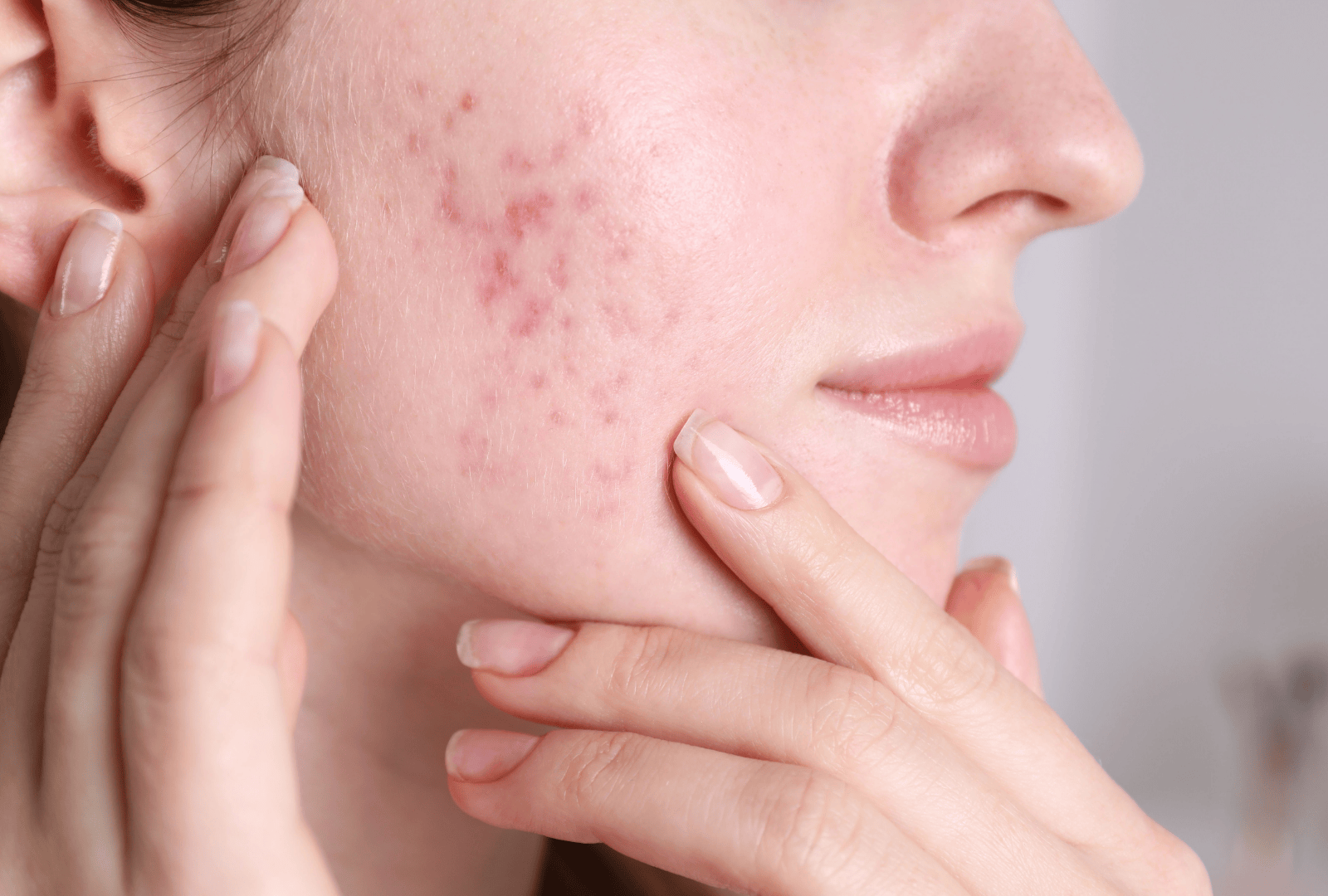 ACNE (4)
