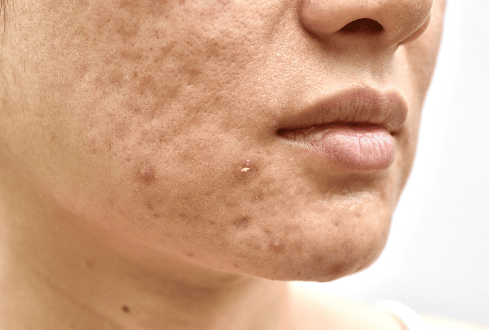 ACNE (6)