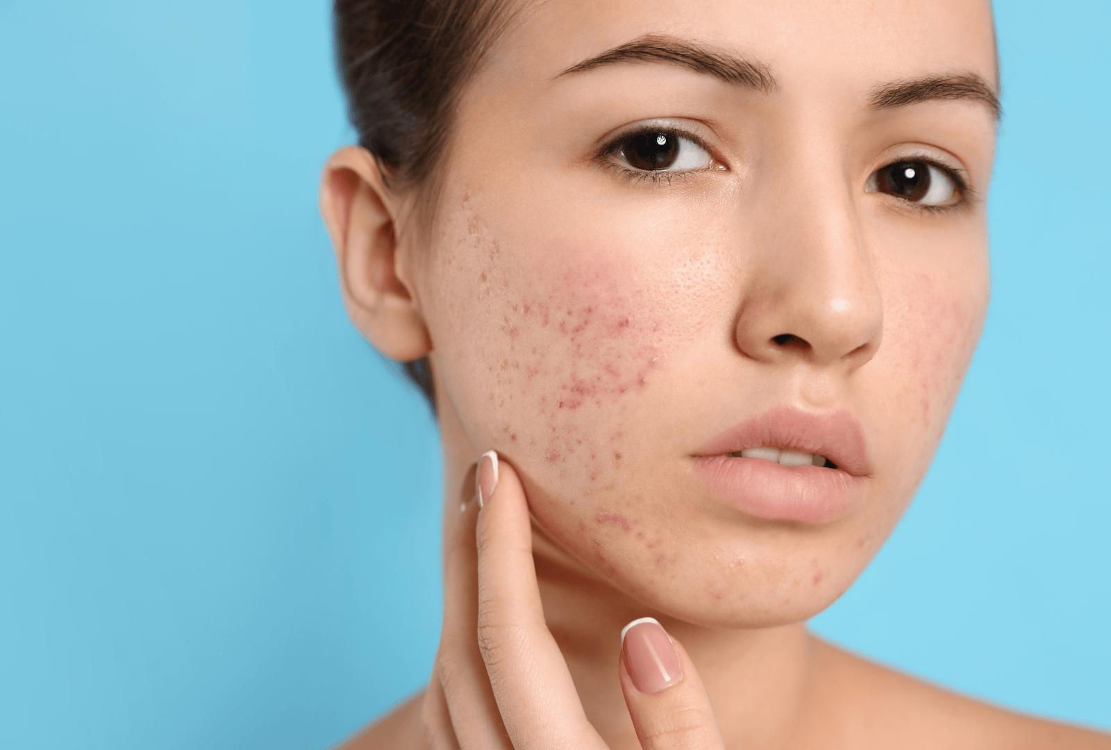 ACNE (7)