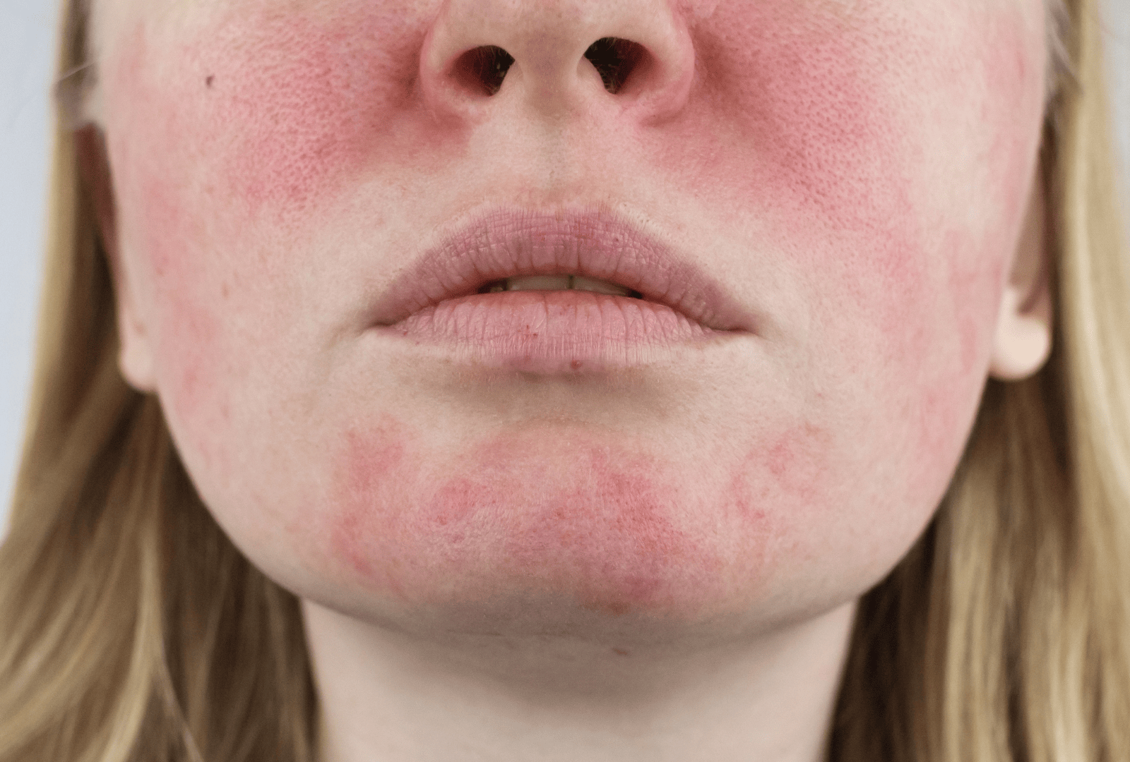 ACNE (8)