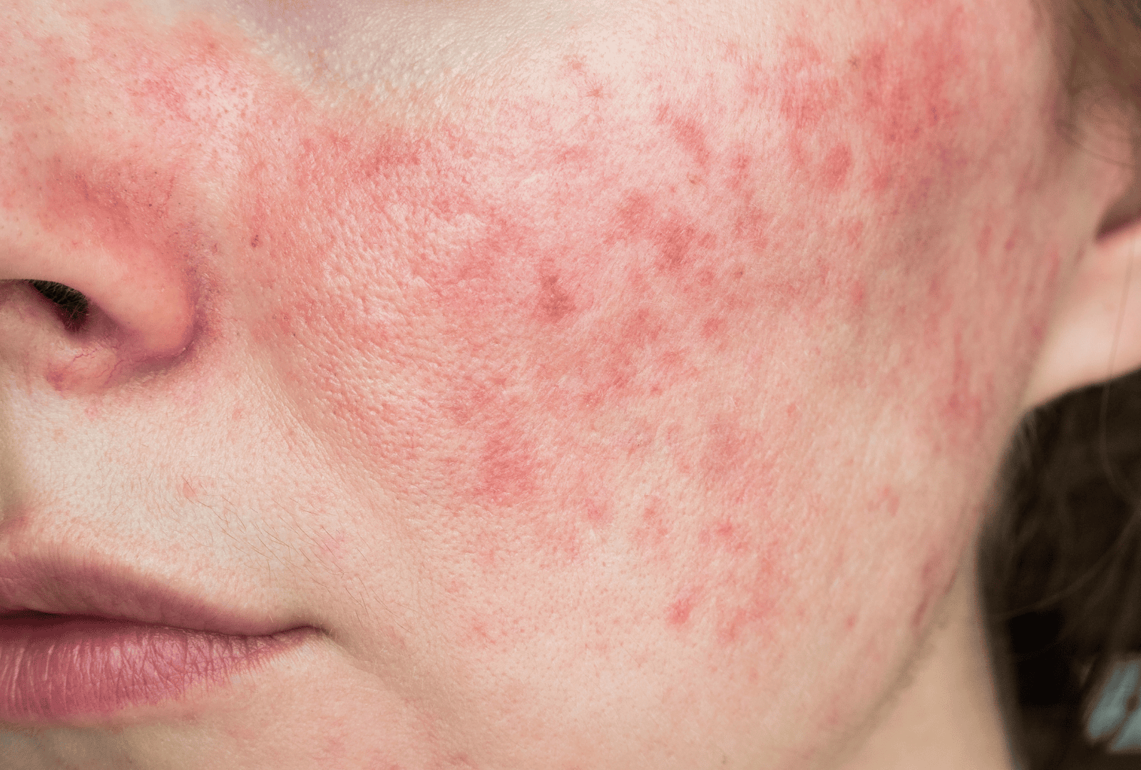ACNE (9)