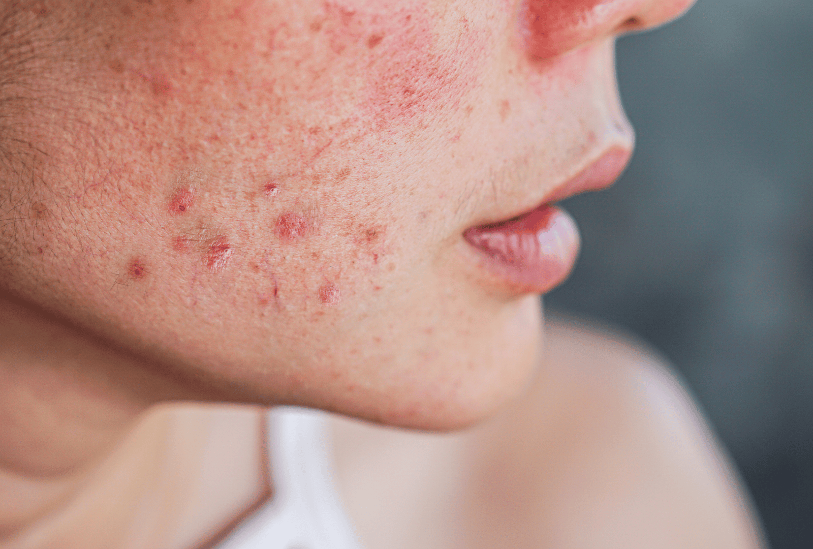 ACNE