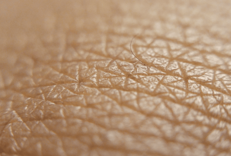 DRY SKIN