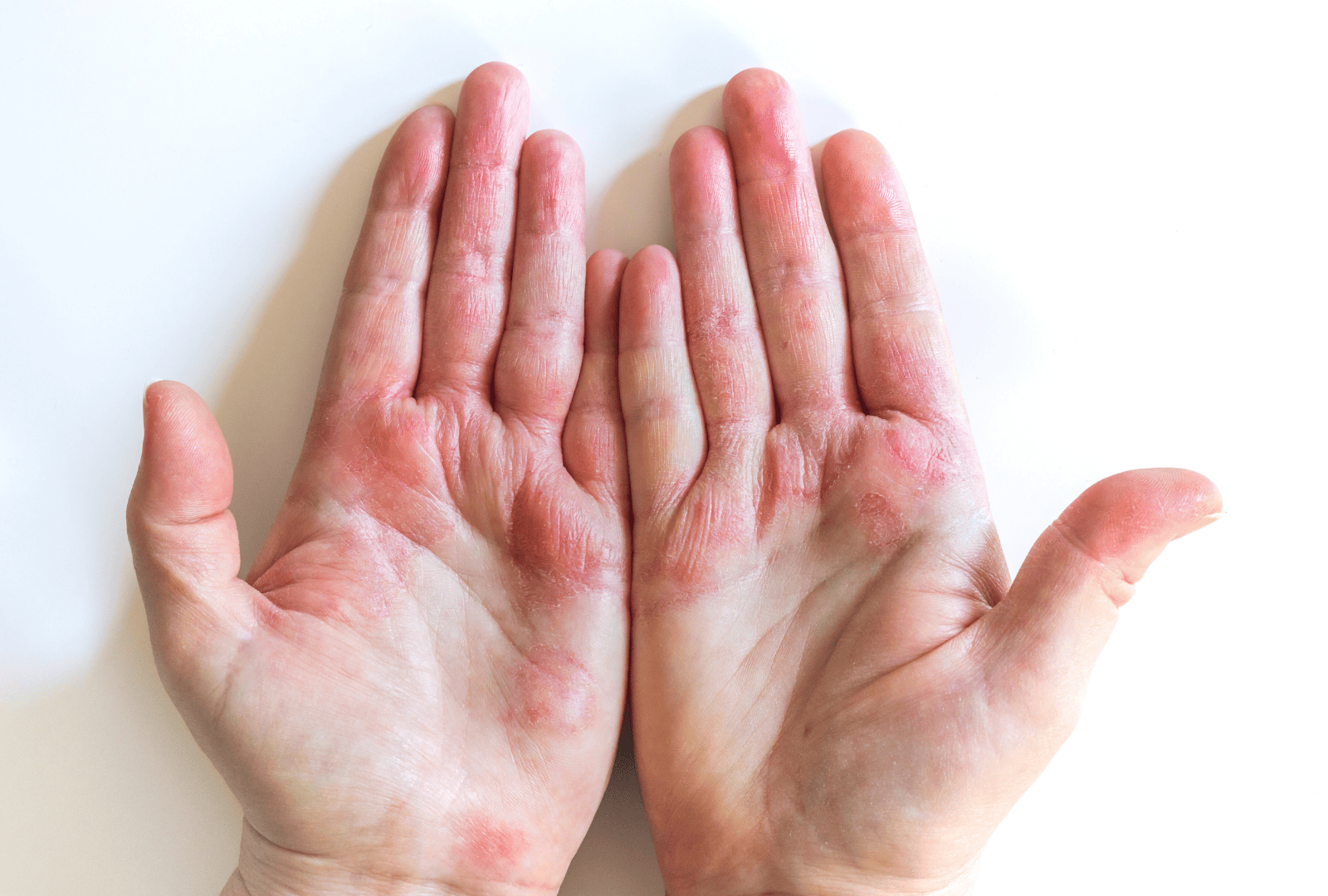 ECZEMA (1)