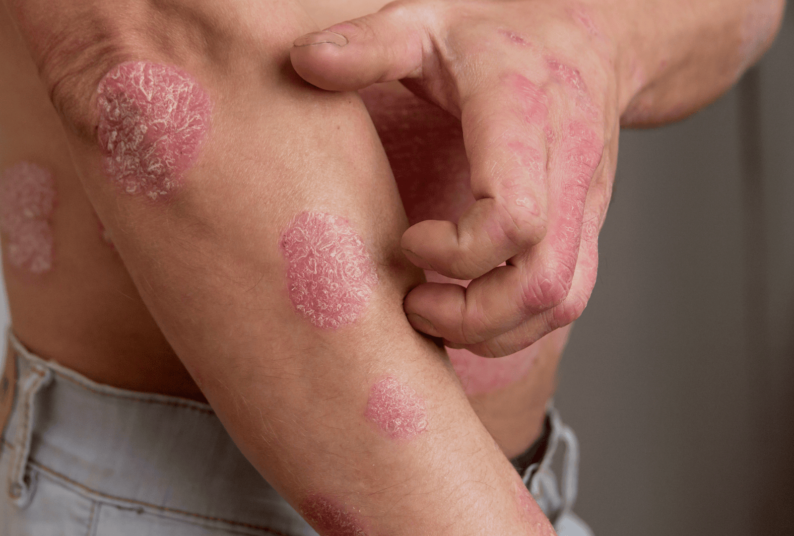 ECZEMA (2)