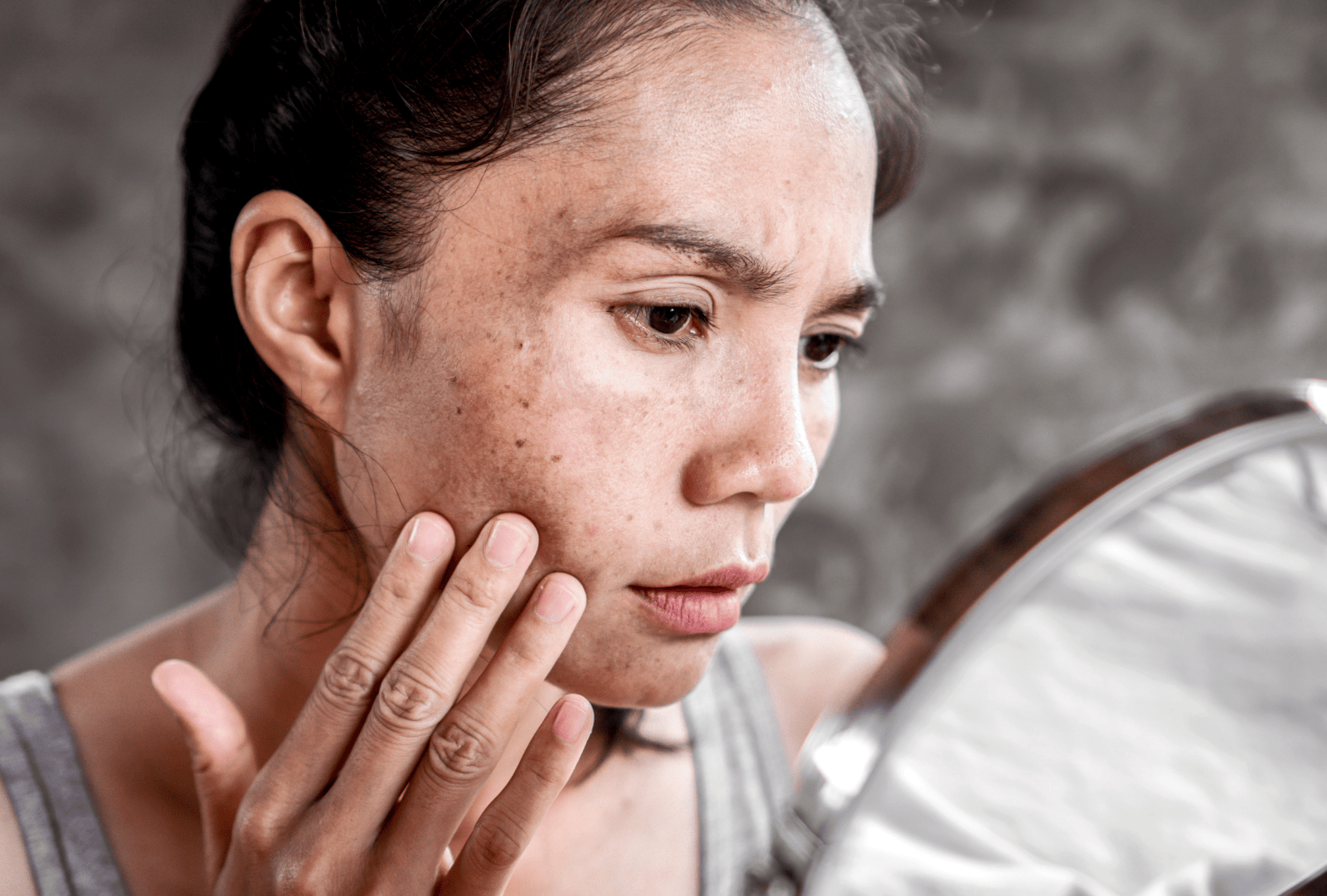 ECZEMA (5)