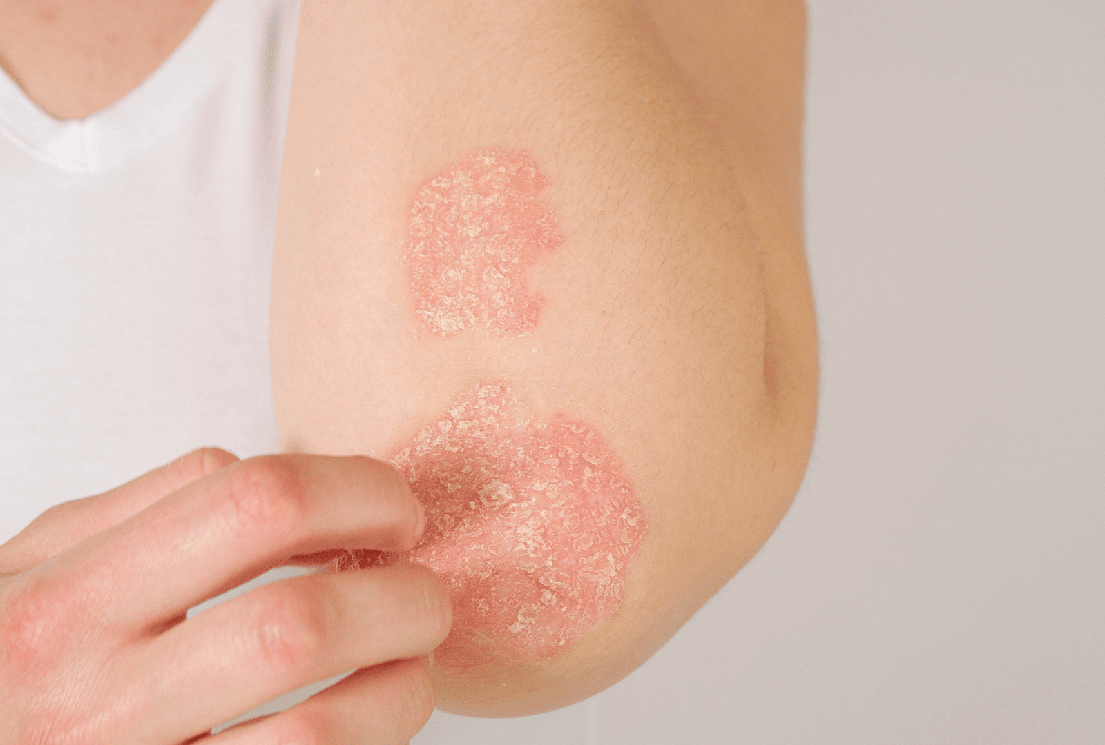 ECZEMA