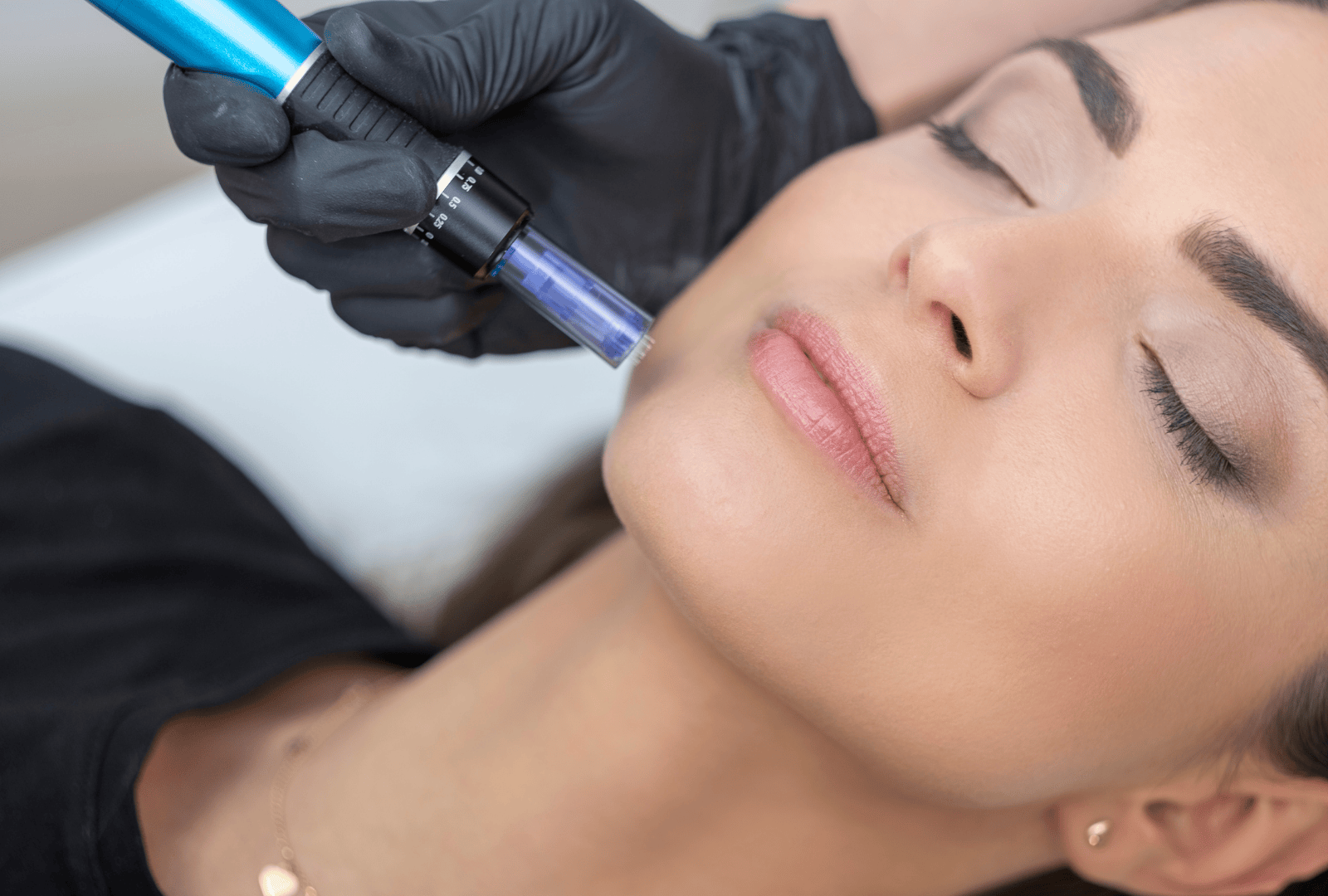 IPL PHOTO FACIAL (3)