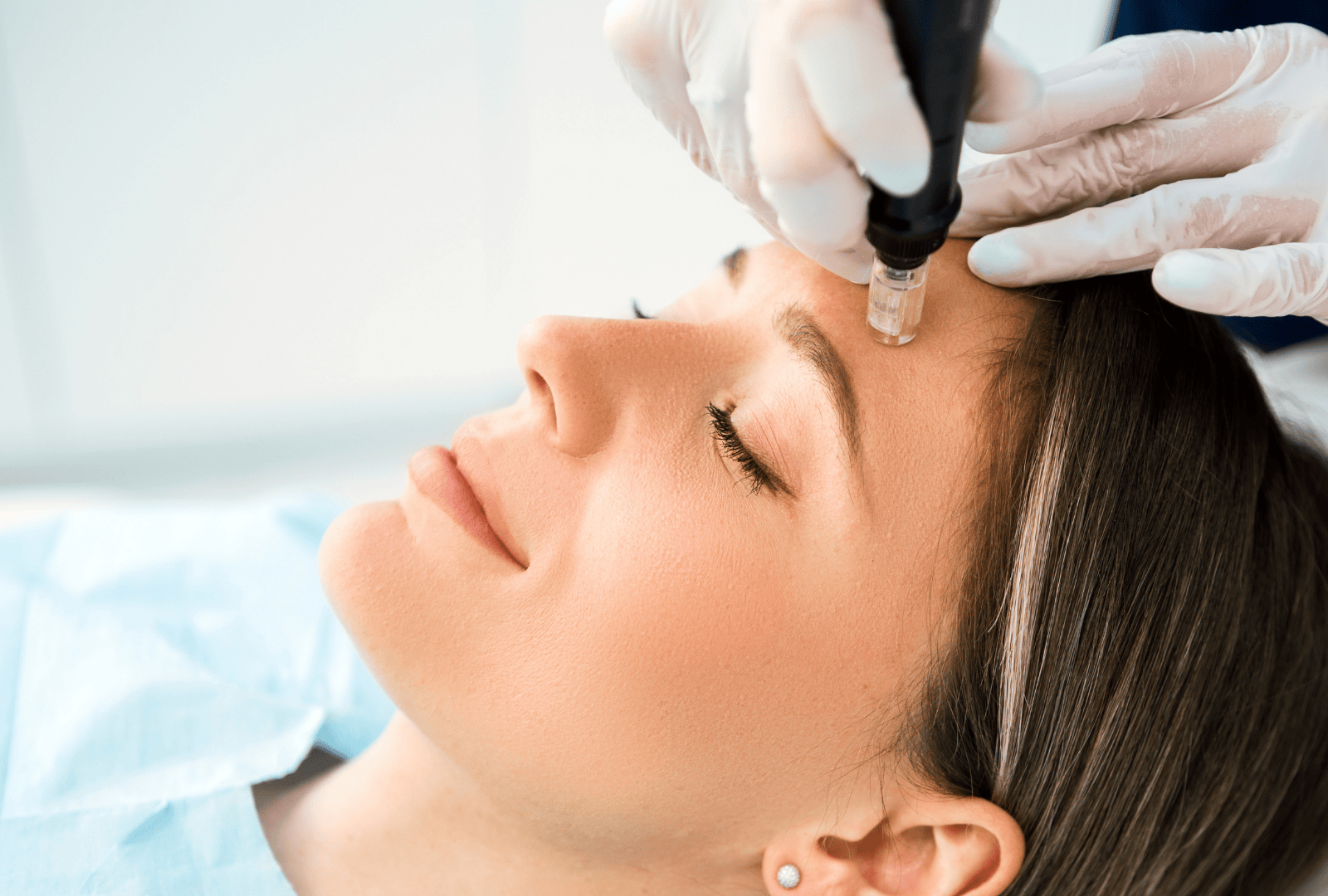 IPL PHOTO FACIAL (4)