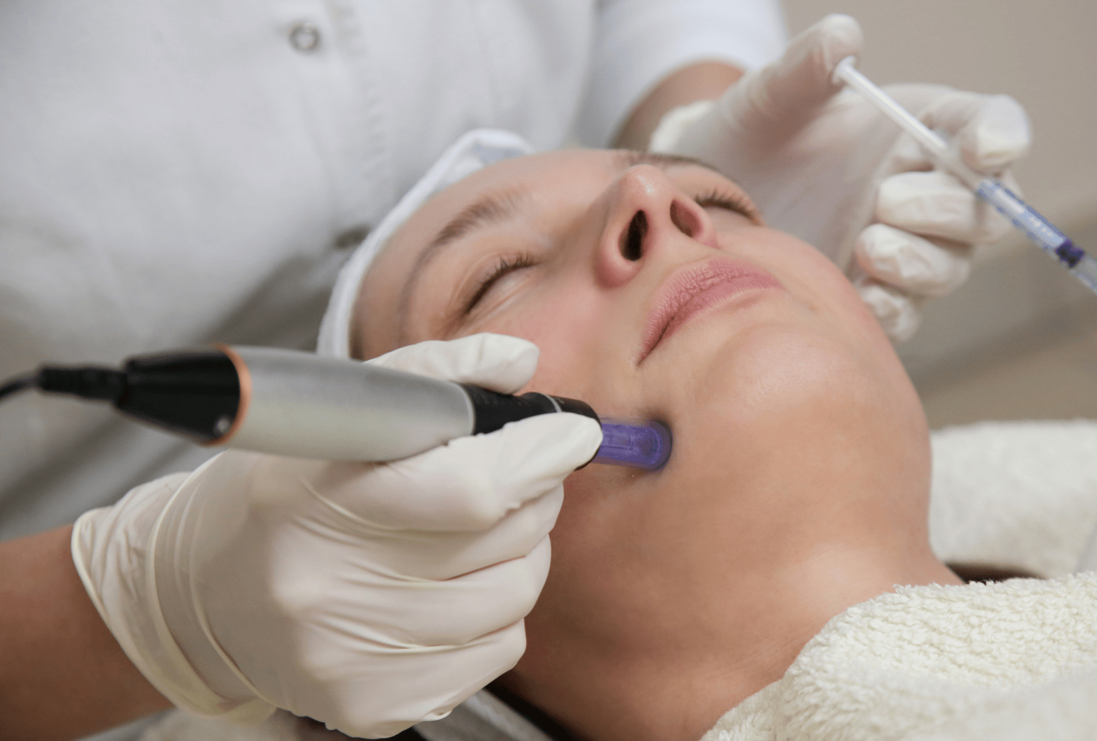 IPL PHOTO FACIAL (5)