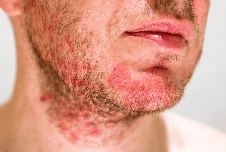 SEBORRHEIC DERMATITIS