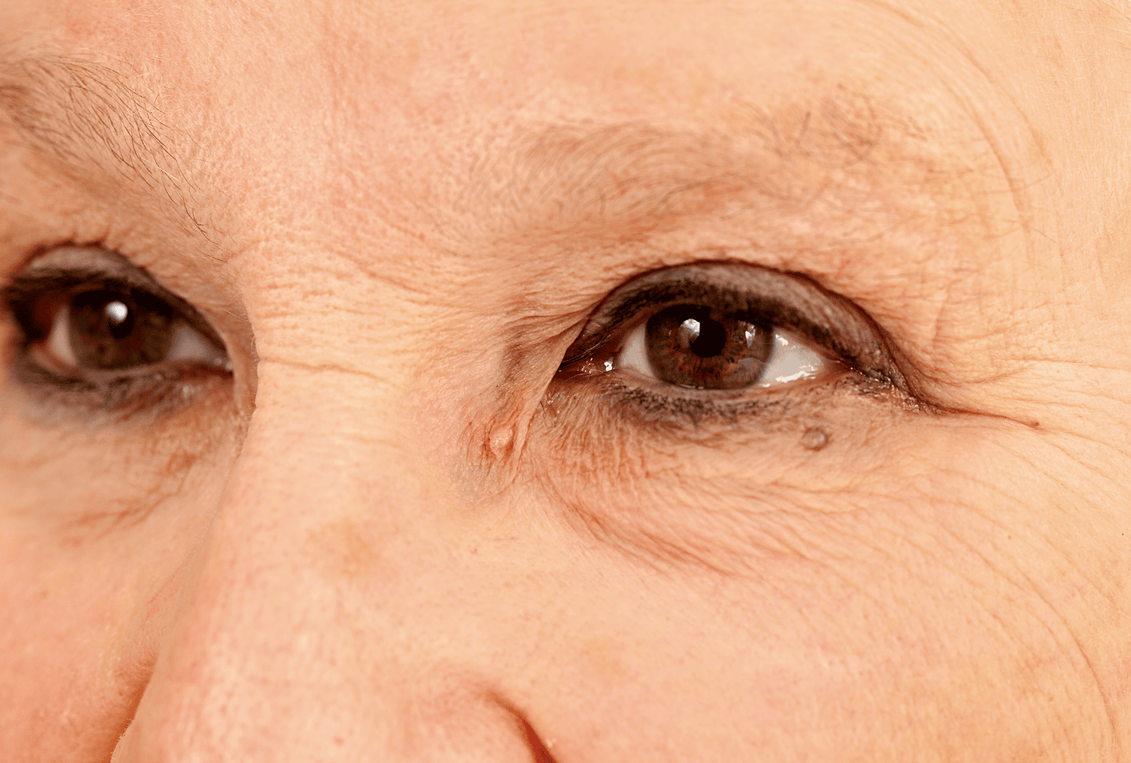 XANTHELASMA PALPEBRARUM (1)