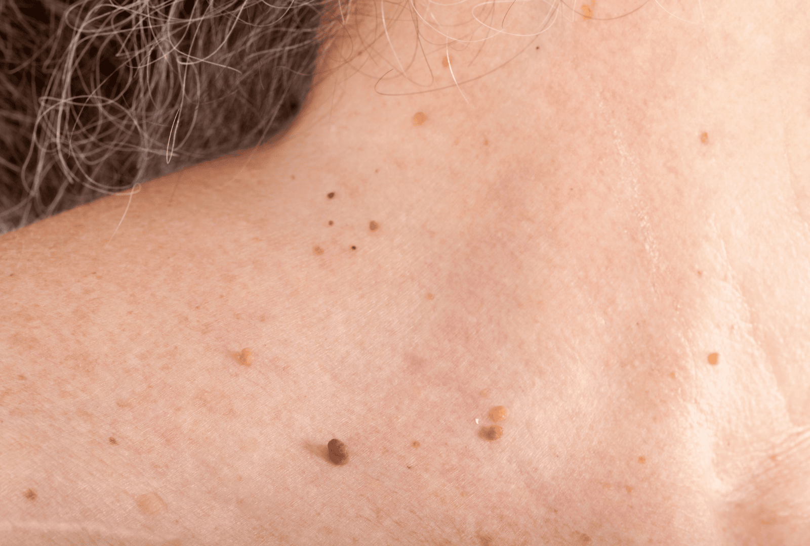 XANTHELASMA PALPEBRARUM (2)