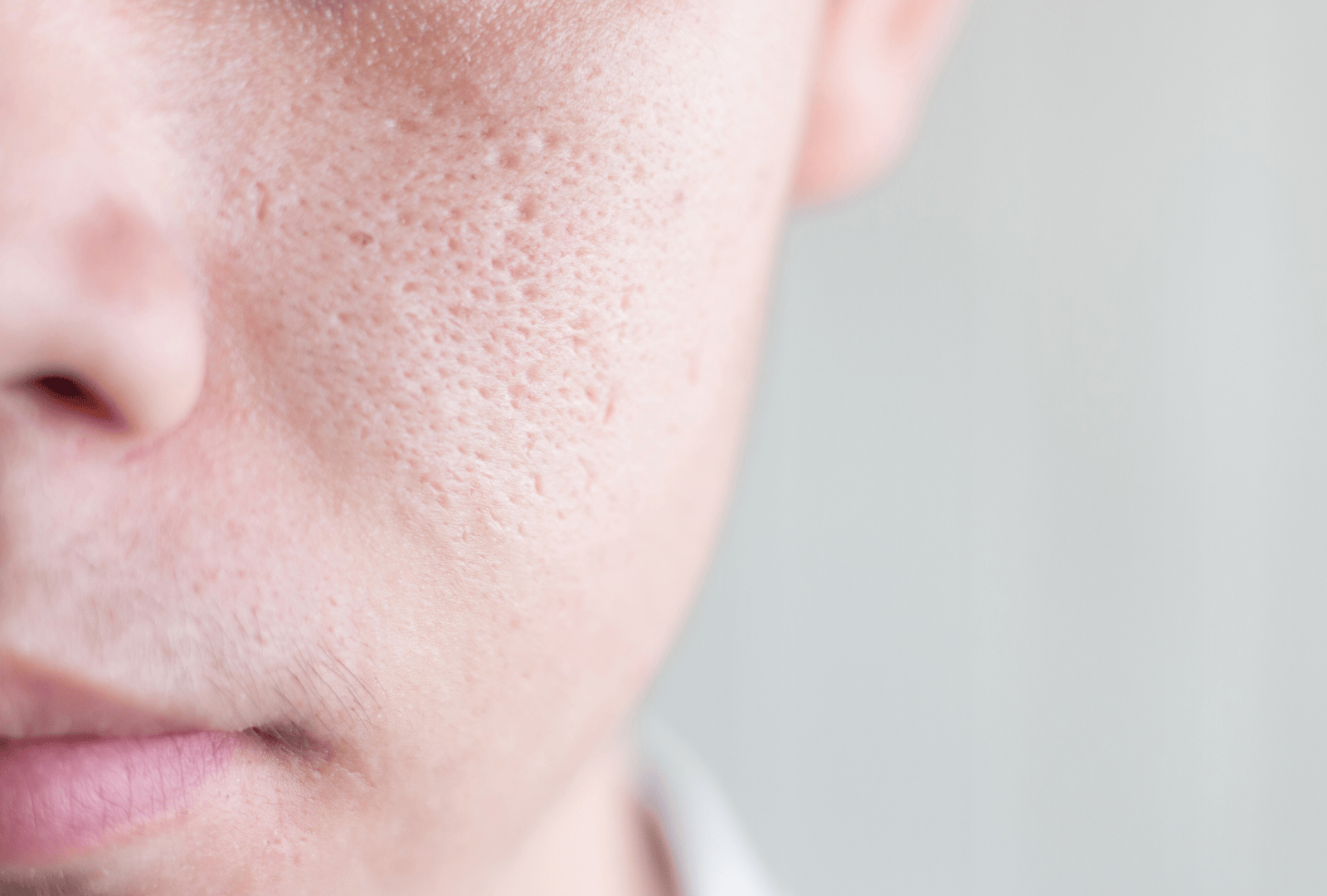XANTHELASMA PALPEBRARUM (4)