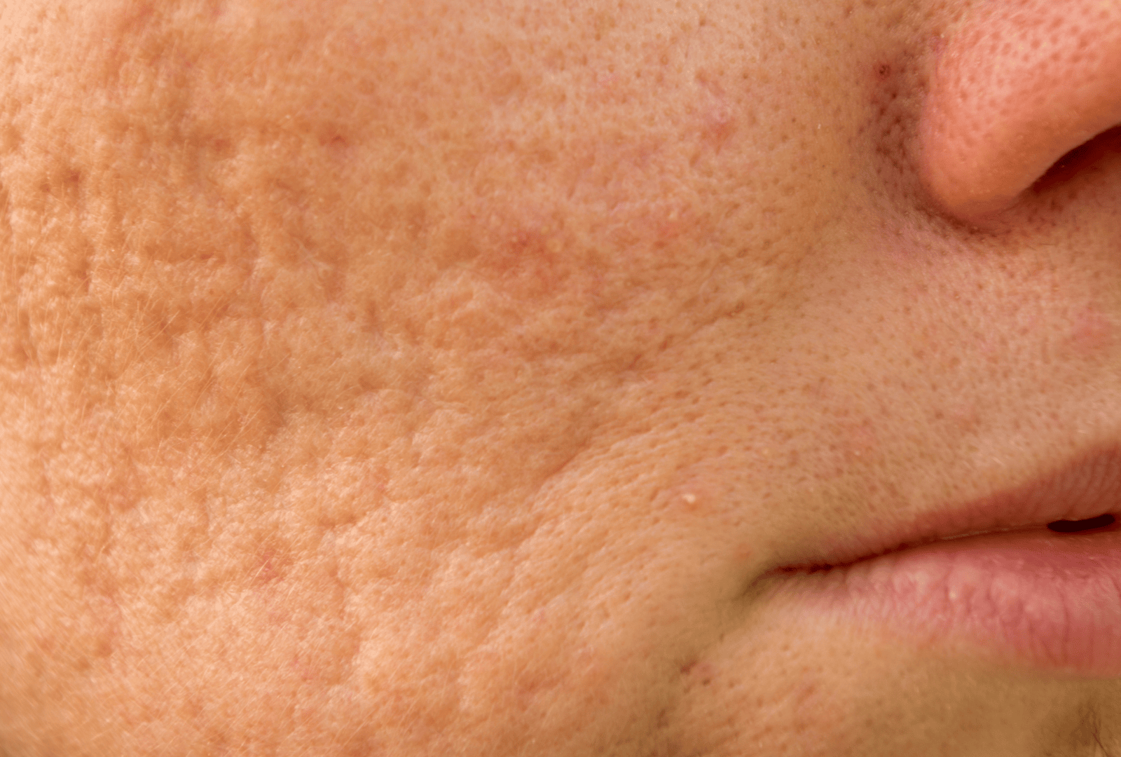 XANTHELASMA PALPEBRARUM (5)