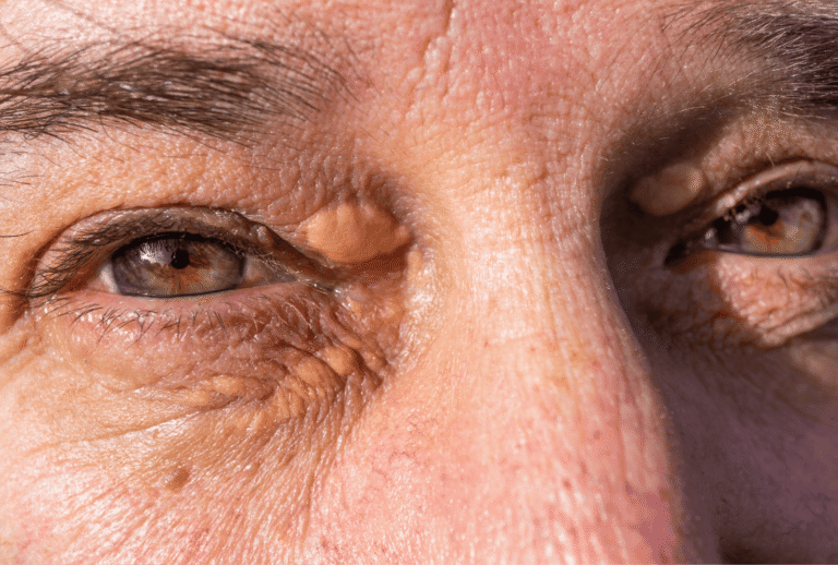 XANTHELASMA PALPEBRARUM