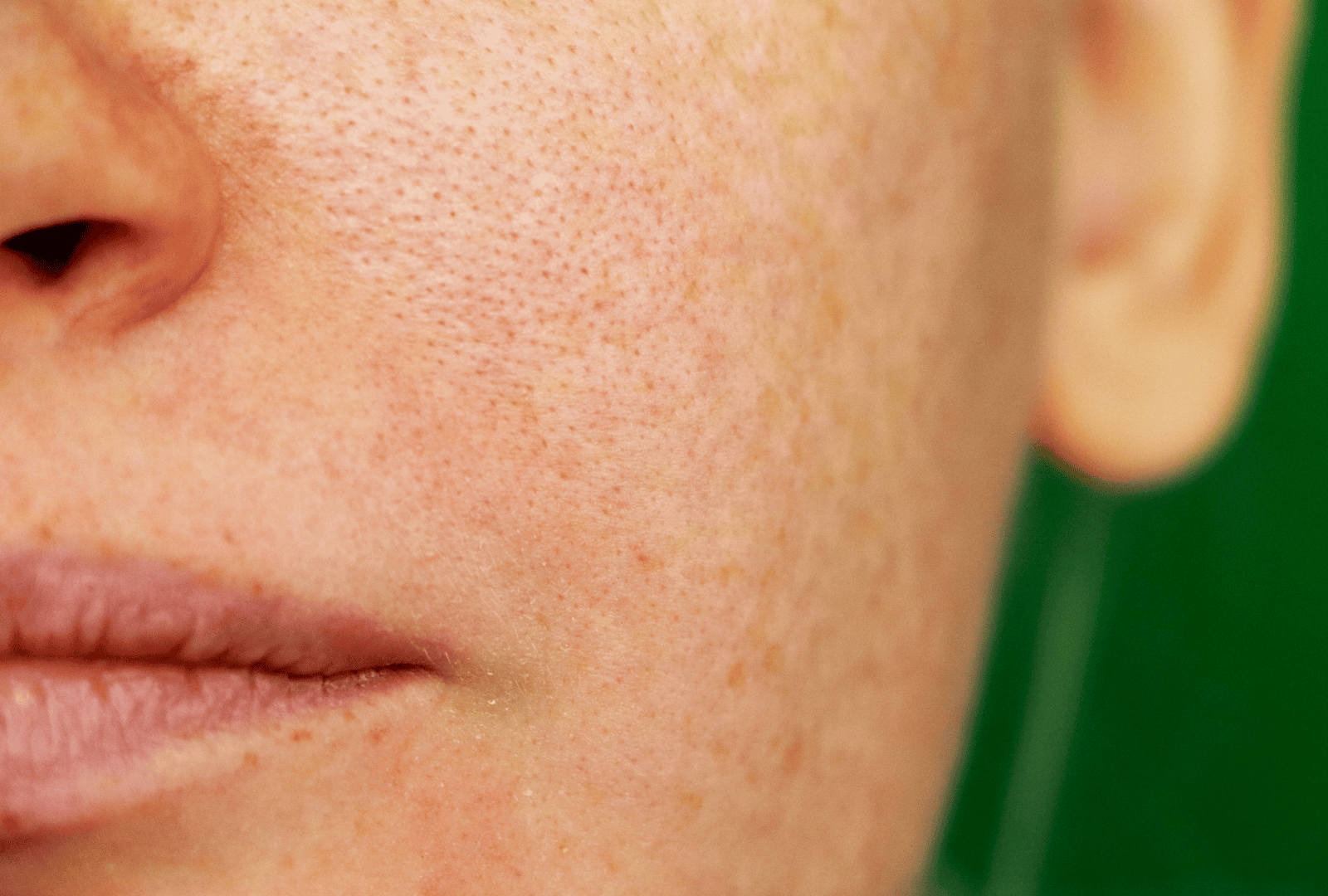 Pigmentation & melasma treatment (1)