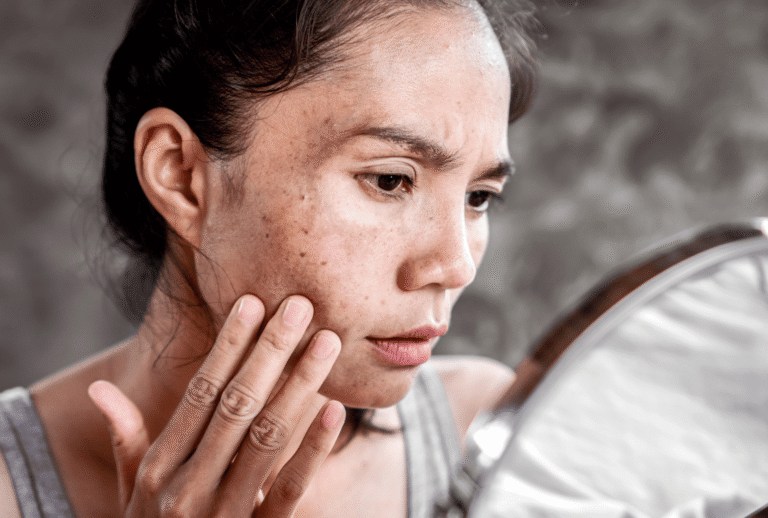 Pigmentation & melasma treatment