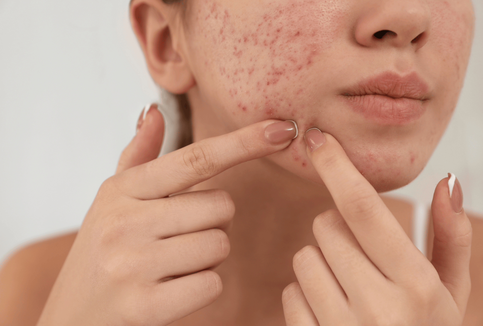 Pimple scar treatment (1)